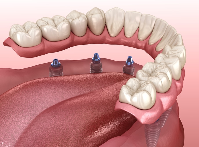 everett denture center everett denture center